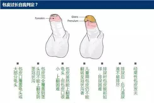 包皮到底要不要割？先搞懂這8個(gè)問題！